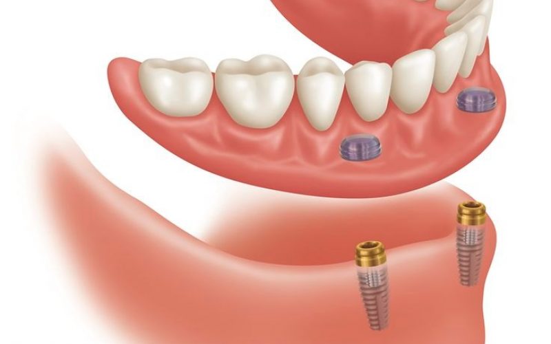 Best Dental implants services in Toronto