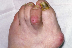 Toe Pain – An Overview