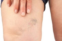 Types Of Varicose Veins You Should Know About