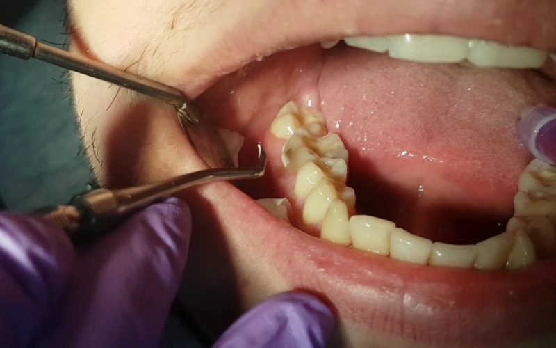 What Do You Know About Tooth Fillings?