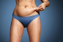Top Information you need to know before Coolsculpting Procedures