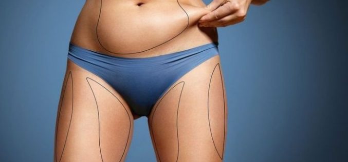 Top Information you need to know before Coolsculpting Procedures