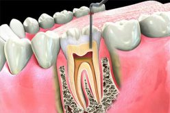 All That You Must Know About Root Canal Procedure