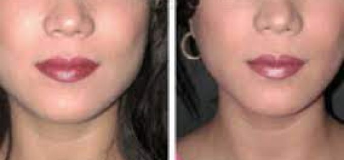 Achieving a Slimmer Jawline with Botox: Your Guide to Jaw Reduction